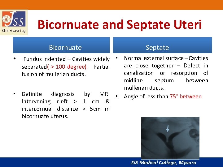 Bicornuate and Septate Uteri Bicornuate Septate • Fundus indented – Cavities widely • Normal