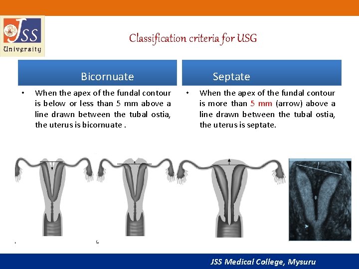 Classification criteria for USG Bicornuate • When the apex of the fundal contour is