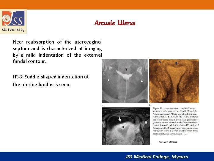 Arcuate Uterus Near reabsorption of the uterovaginal septum and is characterized at imaging by