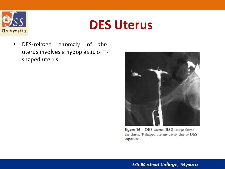 DES Uterus • DES-related anomaly of the uterus involves a hypoplastic or Tshaped uterus.