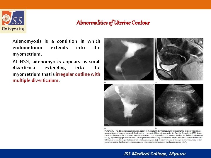 Abnormalities of Uterine Contour Adenomyosis is a condition in which endometrium extends into the