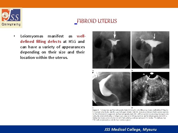  FIBROID UTERUS • Leiomyomas manifest as welldefined filling defects at HSG and can