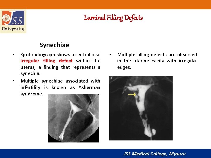 Luminal Filling Defects Synechiae • • Spot radiograph shows a central oval irregular filling