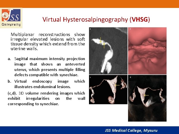 Virtual Hysterosalpingography (VHSG) Multiplanar reconstructions show irregular elevated lesions with soft tissue density which