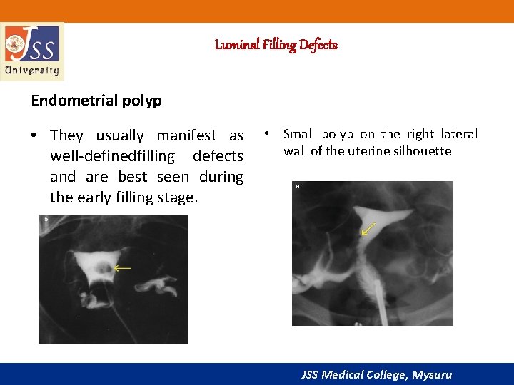 Luminal Filling Defects Endometrial polyp • They usually manifest as • Small polyp on