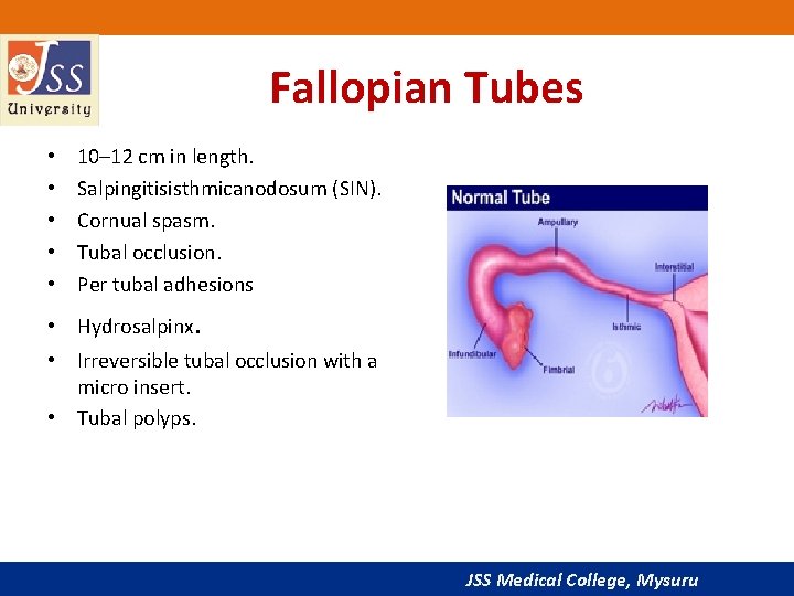 Fallopian Tubes • • • 10– 12 cm in length. Salpingitisisthmicanodosum (SIN). Cornual spasm.
