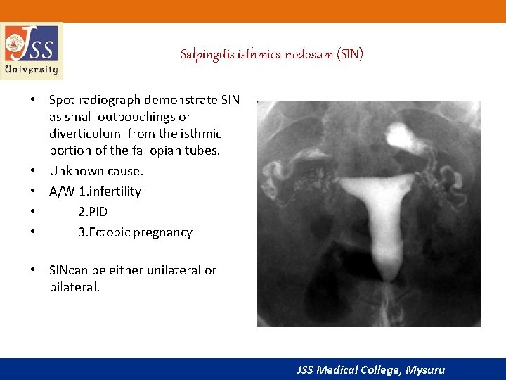 Salpingitis isthmica nodosum (SIN) • Spot radiograph demonstrate SIN as small outpouchings or diverticulum