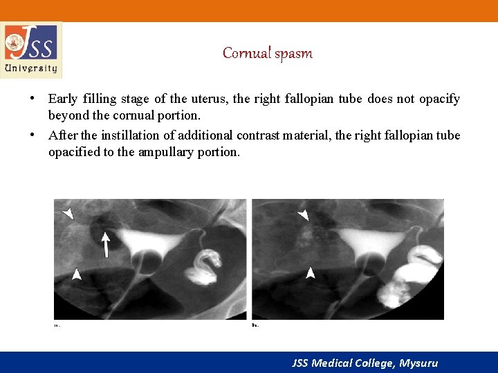 Cornual spasm • Early filling stage of the uterus, the right fallopian tube does