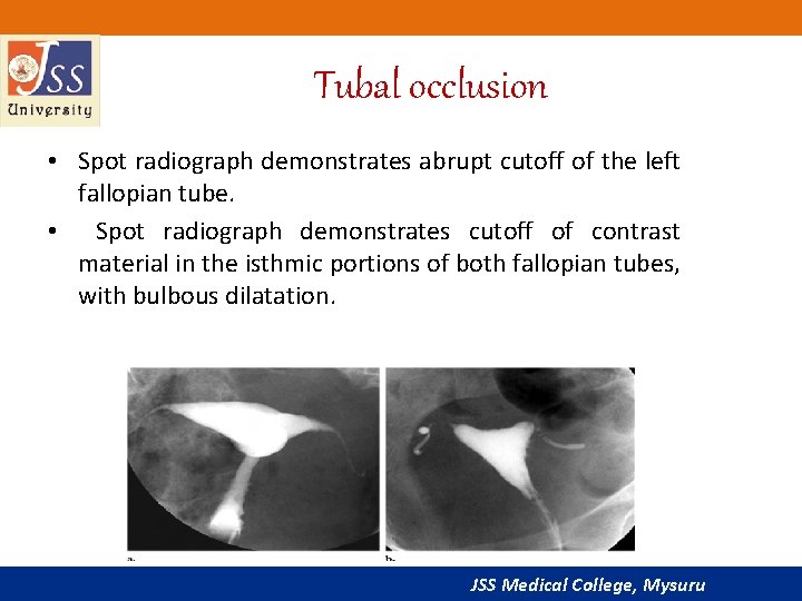 Tubal occlusion • Spot radiograph demonstrates abrupt cutoff of the left fallopian tube. •