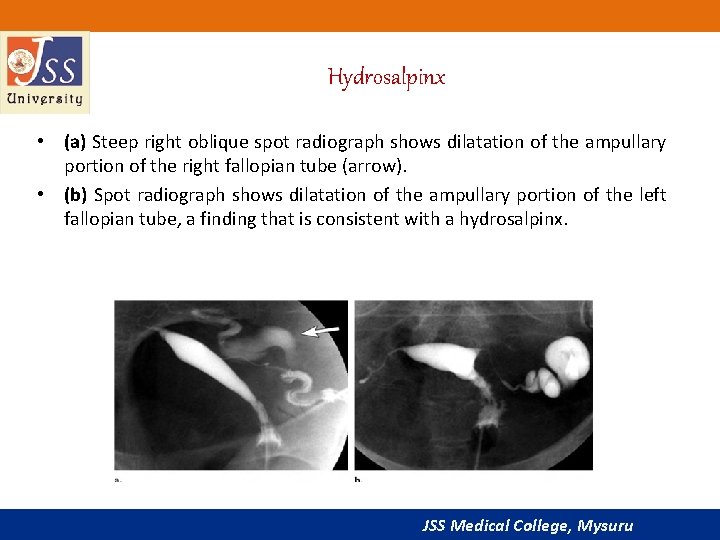 Hydrosalpinx • (a) Steep right oblique spot radiograph shows dilatation of the ampullary portion