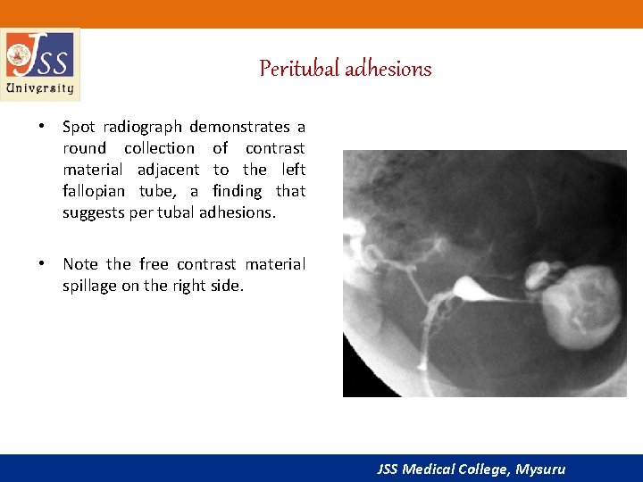 Peritubal adhesions • Spot radiograph demonstrates a round collection of contrast material adjacent to
