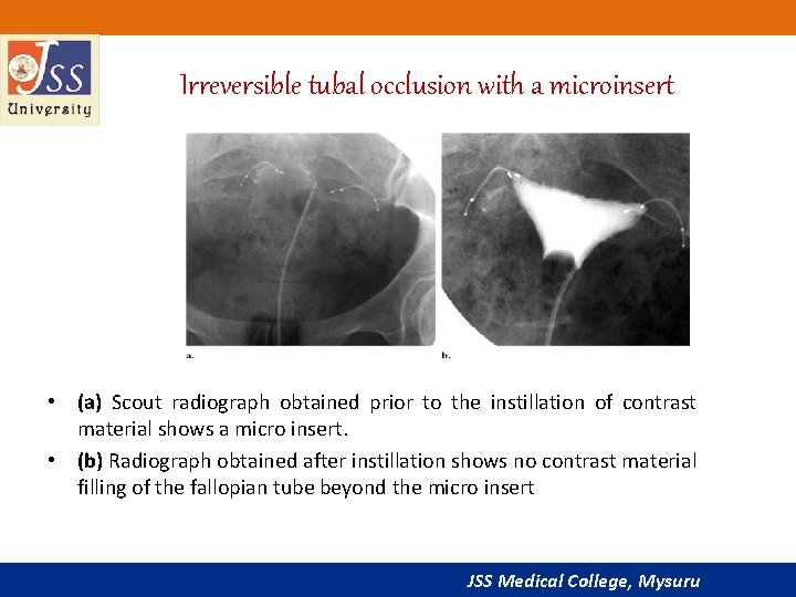 Irreversible tubal occlusion with a microinsert • (a) Scout radiograph obtained prior to the