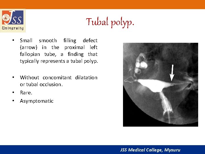 Tubal polyp. • Small smooth filling defect (arrow) in the proximal left fallopian tube,