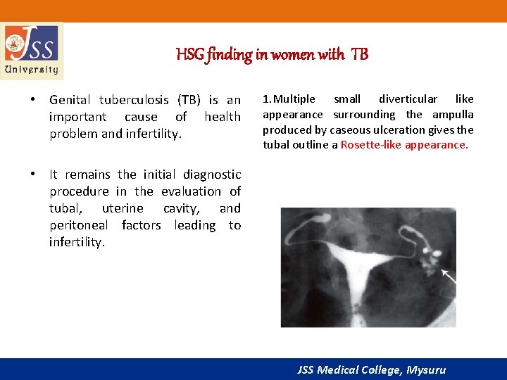 HSG finding in women with TB • Genital tuberculosis (TB) is an important cause