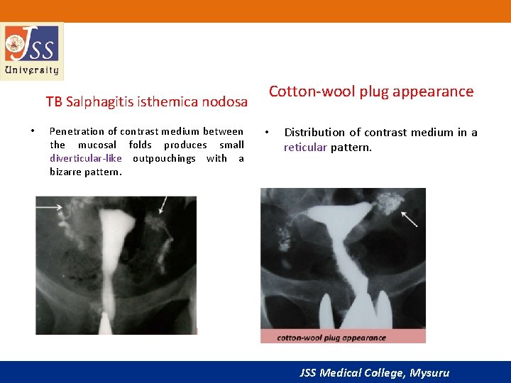  TB Salphagitis isthemica nodosa • Penetration of contrast medium between the mucosal folds
