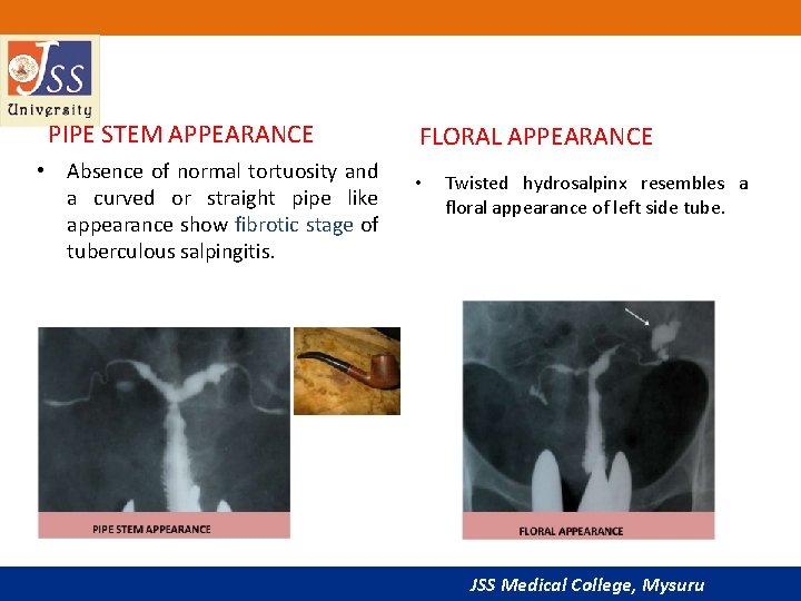 PIPE STEM APPEARANCE • Absence of normal tortuosity and a curved or straight pipe