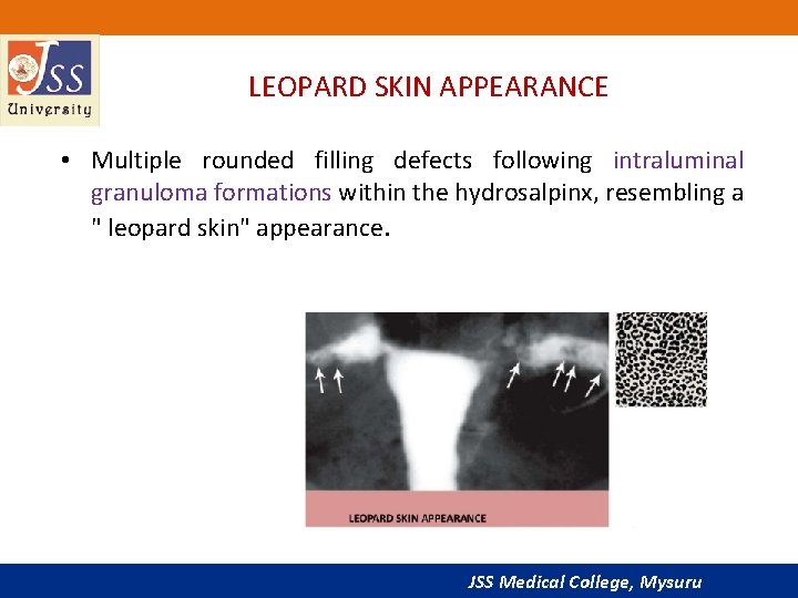 LEOPARD SKIN APPEARANCE • Multiple rounded filling defects following intraluminal granuloma formations within the