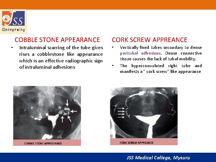 COBBLE STONE APPEARANCE • Intraluminal scarring of the tube gives rises a cobblestone like