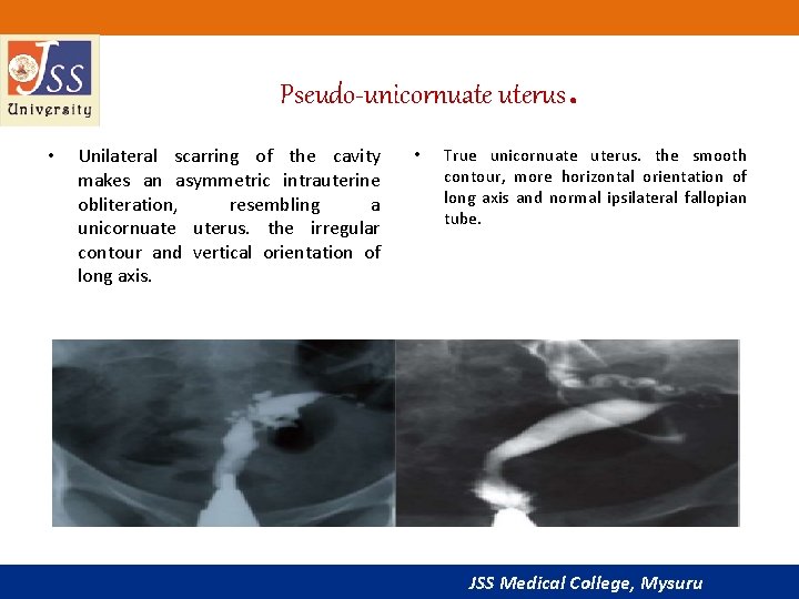 Pseudo-unicornuate uterus. • Unilateral scarring of the cavity makes an asymmetric intrauterine obliteration, resembling