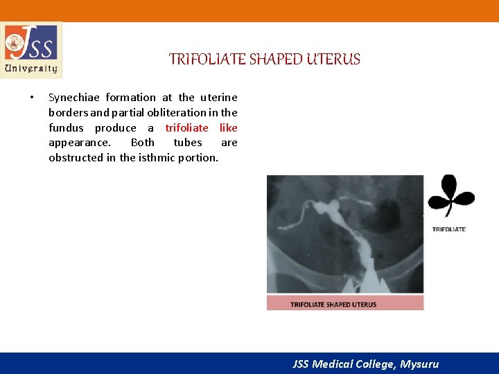 TRIFOLIATE SHAPED UTERUS • Synechiae formation at the uterine borders and partial obliteration in