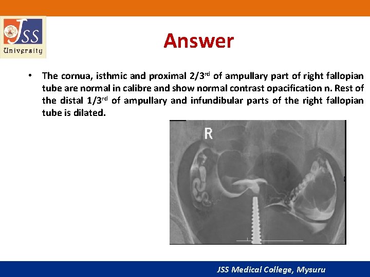 Answer • The cornua, isthmic and proximal 2/3 rd of ampullary part of right