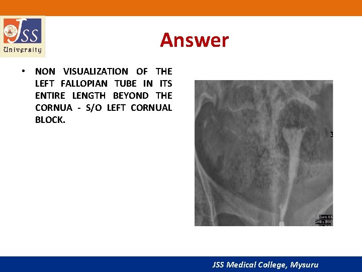 Answer • NON VISUALIZATION OF THE LEFT FALLOPIAN TUBE IN ITS ENTIRE LENGTH BEYOND