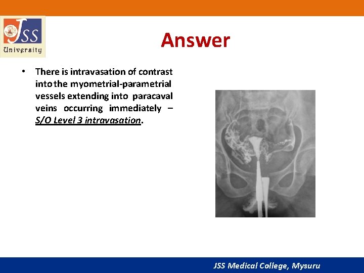 Answer • There is intravasation of contrast into the myometrial-parametrial vessels extending into paracaval