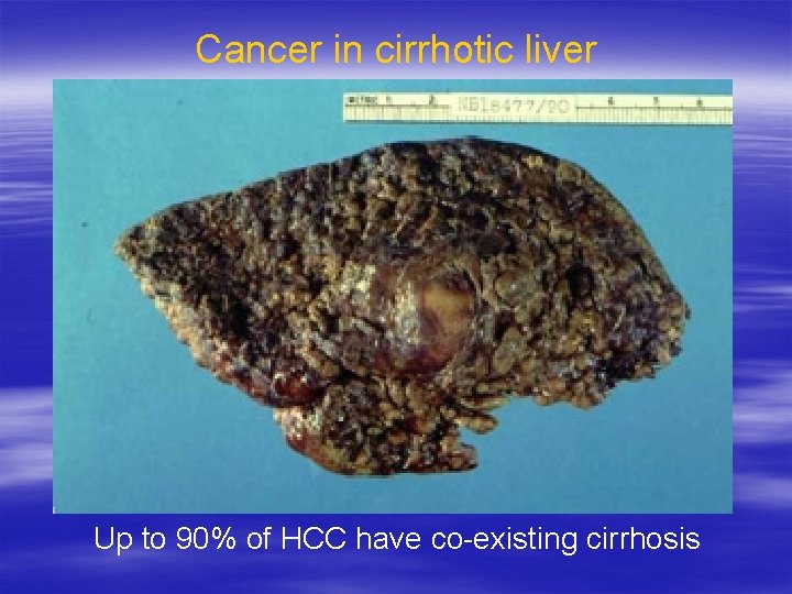 Cancer in cirrhotic liver Up to 90% of HCC have co-existing cirrhosis 