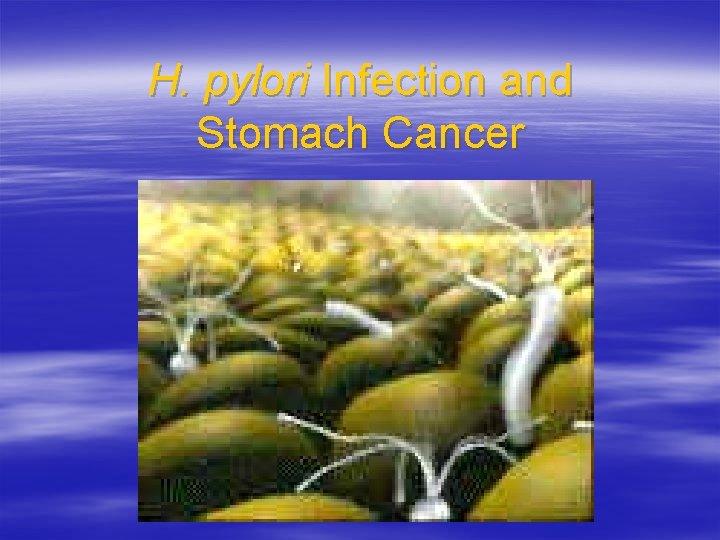 H. pylori Infection and Stomach Cancer 