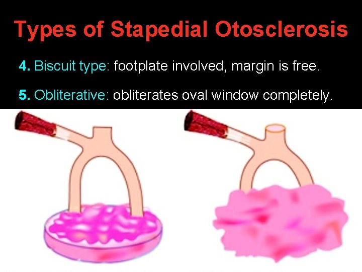 Types of Stapedial Otosclerosis 4. Biscuit type: footplate involved, margin is free. 5. Obliterative: Types of Stapedial Otosclerosis 4. Biscuit type: footplate involved, margin is free. 5. Obliterative: