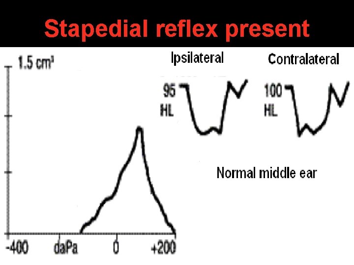 Stapedial reflex present Stapedial reflex present