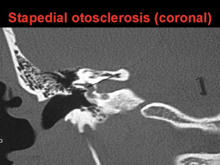 Stapedial otosclerosis (coronal) Stapedial otosclerosis (coronal)