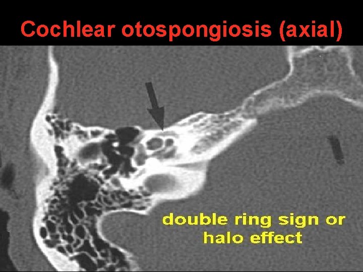 Cochlear otospongiosis (axial) Cochlear otospongiosis (axial)