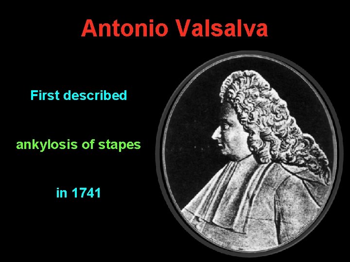 Antonio Valsalva First described ankylosis of stapes in 1741 Antonio Valsalva First described ankylosis of stapes in 1741