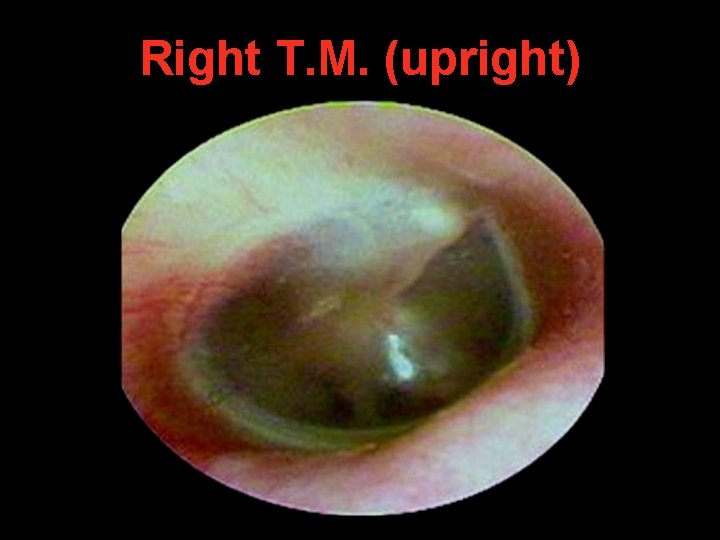 Right T. M. (upright) Right T. M. (upright)