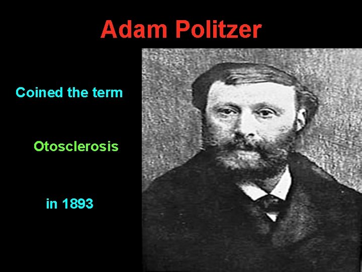 Adam Politzer Coined the term Otosclerosis in 1893 Adam Politzer Coined the term Otosclerosis in 1893