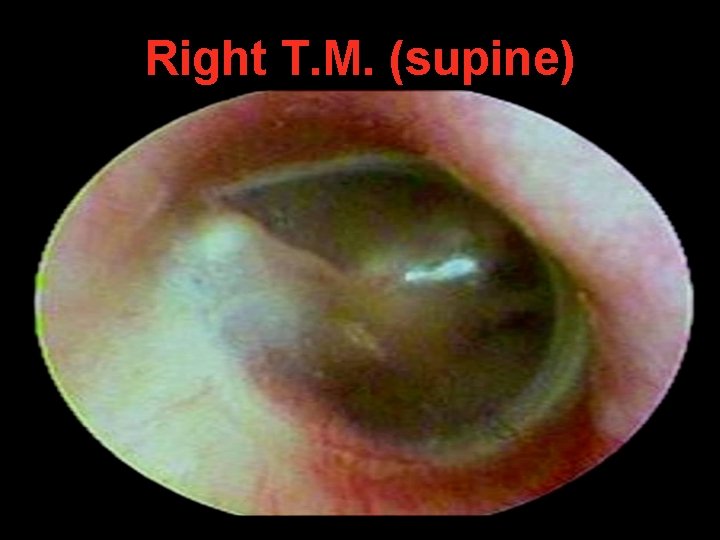 Right T. M. (supine) Right T. M. (supine)