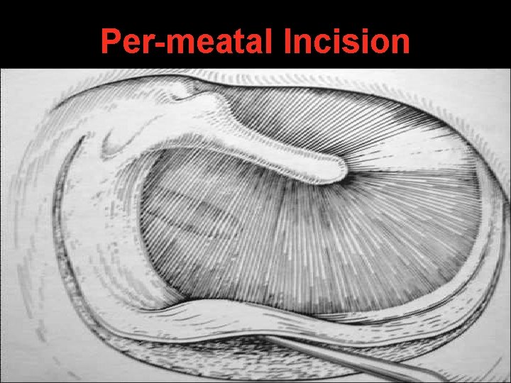 Per-meatal Incision Per-meatal Incision