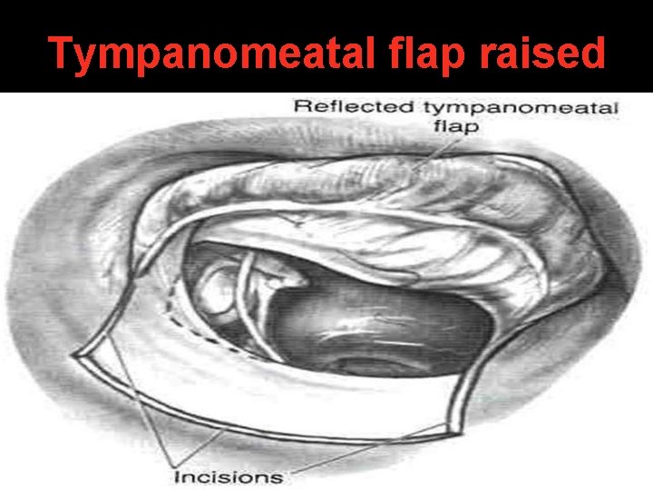 Tympanomeatal flap raised Tympanomeatal flap raised
