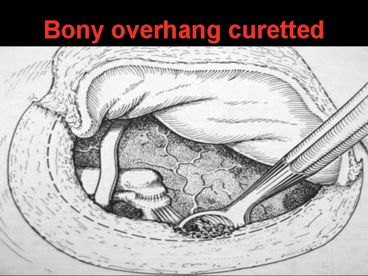 Bony overhang curetted Bony overhang curetted