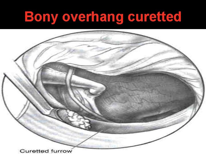 Bony overhang curetted Bony overhang curetted