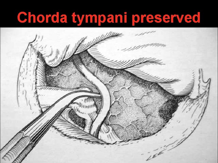 Chorda tympani preserved Chorda tympani preserved