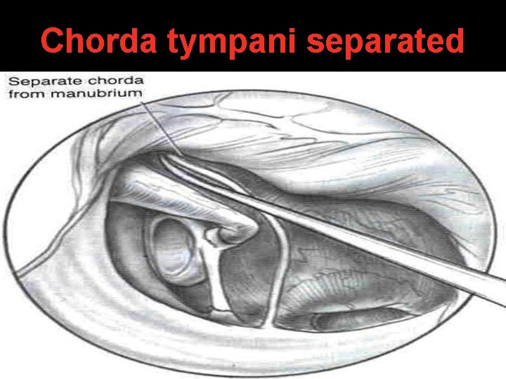 Chorda tympani separated Chorda tympani separated