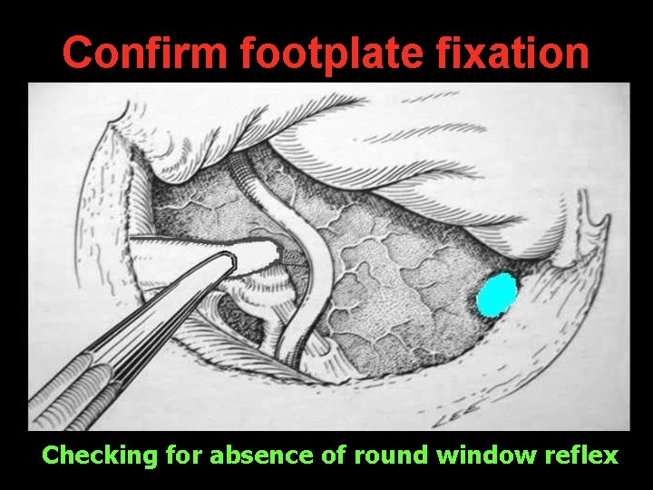 Confirm footplate fixation Checking for absence of round window reflex Confirm footplate fixation Checking for absence of round window reflex