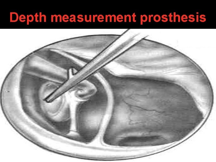 Depth measurement prosthesis Depth measurement prosthesis