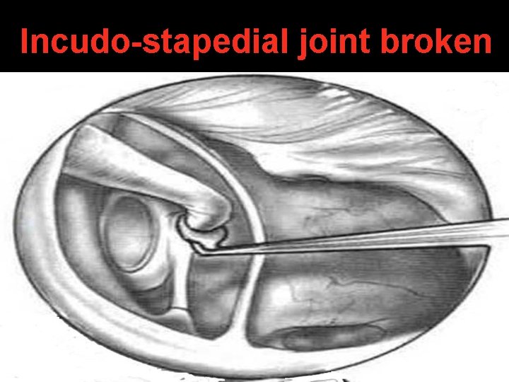 Incudo-stapedial joint broken Incudo-stapedial joint broken