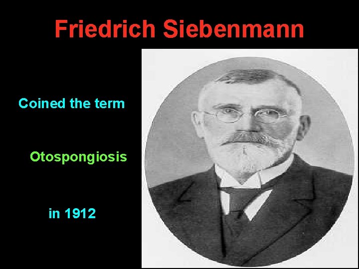 Friedrich Siebenmann Coined the term Otospongiosis in 1912 Friedrich Siebenmann Coined the term Otospongiosis in 1912