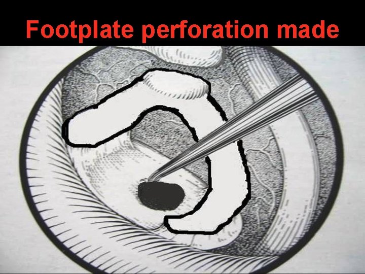 Footplate perforation made Footplate perforation made