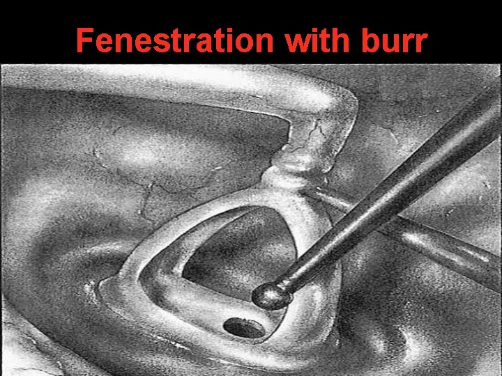 Fenestration with burr Fenestration with burr