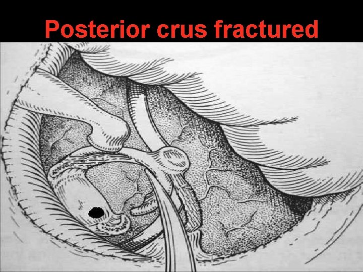 Posterior crus fractured Posterior crus fractured